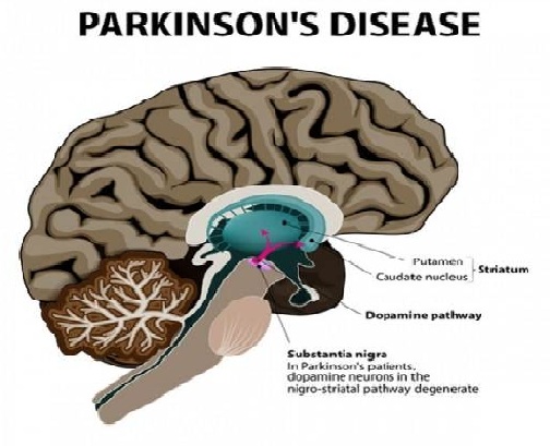 HBOT For Parkinson’s Disease in Aurangabad